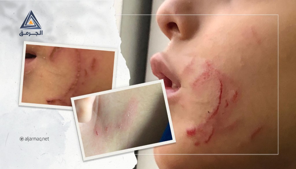 اعتداءات متكررة على طفل فلسطيني بمدرسة إسرائيلية باللد