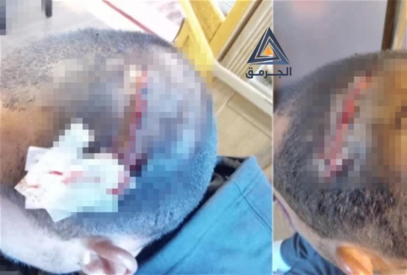 شاب من أم الفحم يتحدث عن الاعتداء الذي تعرض له في الأقصى